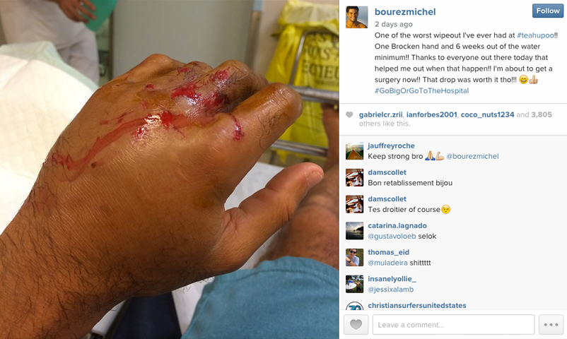Michel Bourez's broken hand, in a photo posted on Instagram after his Teahupoo wipeout
